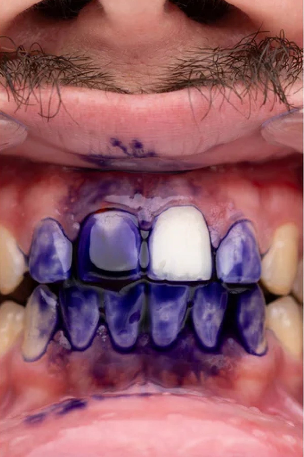 🦷✨ROXO V34 - Branqueamento Dentário🔥Black Friday 2026