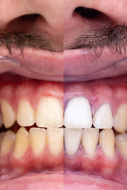 🦷✨ROXO V34 - Branqueamento Dentário🔥Black Friday 2026
