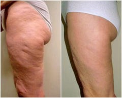 Masajeador Anticelulítico Skintec® Combina succión y calor terapéutico para reducir la grasa localizada y tonificar.✨